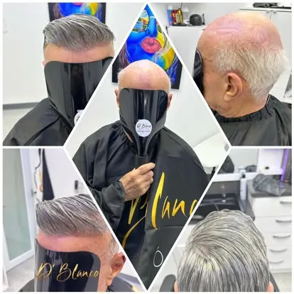 Prótesis capilar — collage del procedimiento